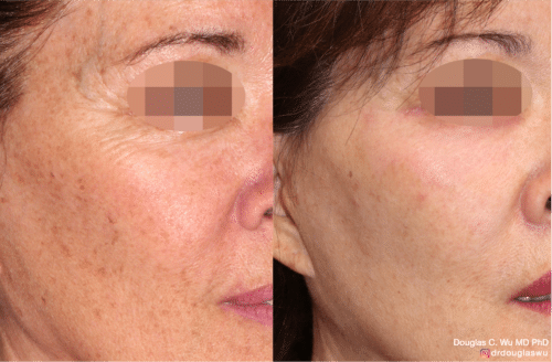 Laser resurfacing is one of the most effective ways to tighten the skin, remove wrinkling and fine lines that give a dull tired appearance.