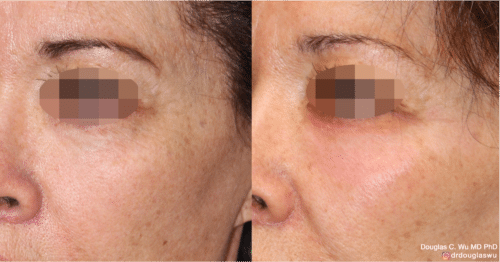 Laser resurfacing is one of the most effective ways to tighten the skin, remove wrinkling and fine lines that give a dull tired appearance.