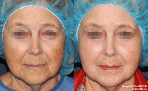 Laser resurfacing is one of the most effective ways to tighten the skin, remove wrinkling and fine lines that give a dull tired appearance.