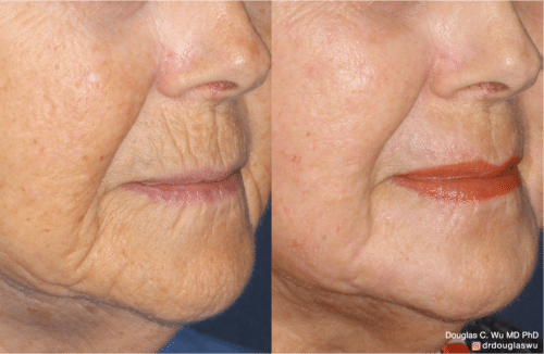 Laser resurfacing is one of the most effective ways to tighten the skin, remove wrinkling and fine lines that give a dull tired appearance.