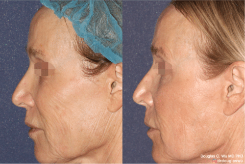 Laser resurfacing is one of the most effective ways to tighten the skin, remove wrinkling and fine lines that give a dull tired appearance.