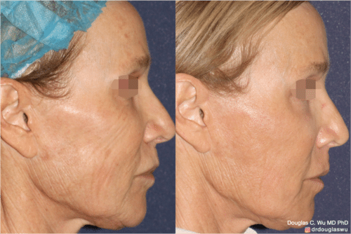 Laser resurfacing is one of the most effective ways to tighten the skin, remove wrinkling and fine lines that give a dull tired appearance.