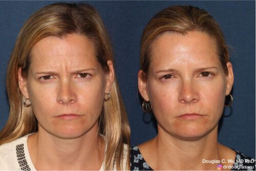 Botox for frown lines