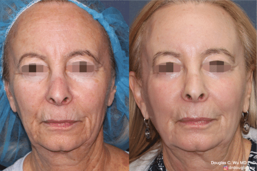 Laser resurfacing is one of the most effective ways to tighten the skin, remove wrinkling and fine lines that give a dull tired appearance.
