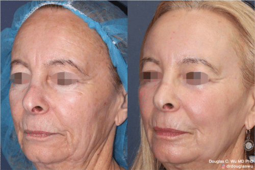 Laser resurfacing is one of the most effective ways to tighten the skin, remove wrinkling and fine lines that give a dull tired appearance.