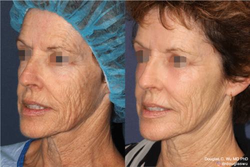 Laser resurfacing is one of the most effective ways to tighten the skin, remove wrinkling and fine lines that give a dull tired appearance.