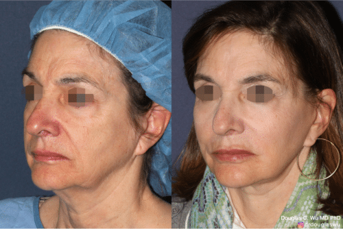 Laser resurfacing is one of the most effective ways to tighten the skin, remove wrinkling and fine lines that give a dull tired appearance.