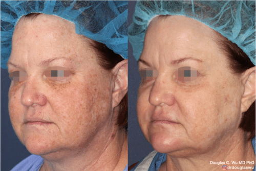 Laser resurfacing is one of the most effective ways to tighten the skin, remove wrinkling and fine lines that give a dull tired appearance.