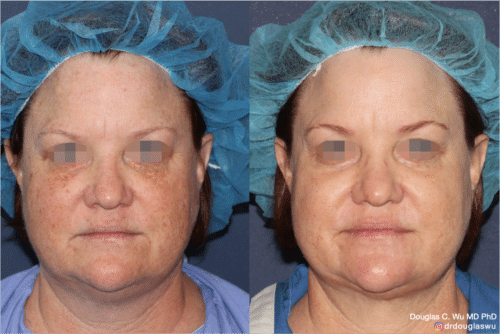 Laser resurfacing is one of the most effective ways to tighten the skin, remove wrinkling and fine lines that give a dull tired appearance.