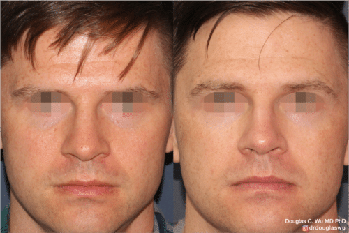 Laser resurfacing is one of the most effective ways to tighten the skin, remove wrinkling and fine lines that give a dull tired appearance.