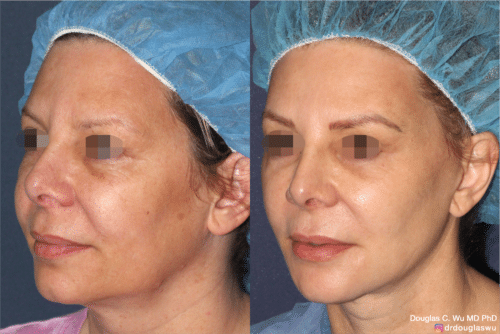 Laser resurfacing is one of the most effective ways to tighten the skin, remove wrinkling and fine lines that give a dull tired appearance.