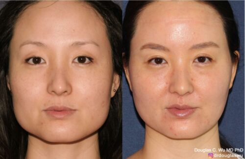Botox for jawline slimming