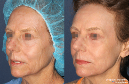 Laser resurfacing is one of the most effective ways to tighten the skin, remove wrinkling and fine lines that give a dull tired appearance.