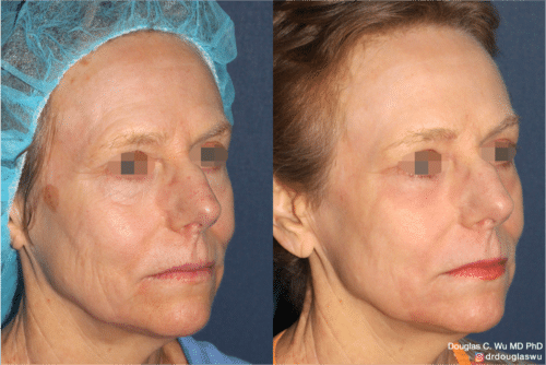 Laser resurfacing is one of the most effective ways to tighten the skin, remove wrinkling and fine lines that give a dull tired appearance.