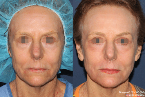 Laser resurfacing is one of the most effective ways to tighten the skin, remove wrinkling and fine lines that give a dull tired appearance.