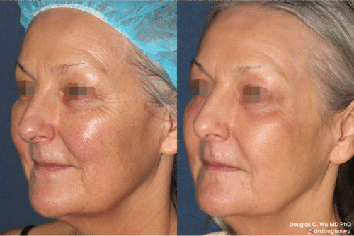 Laser resurfacing is one of the most effective ways to tighten the skin, remove wrinkling and fine lines that give a dull tired appearance.