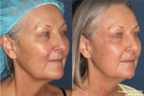 Laser resurfacing is one of the most effective ways to tighten the skin, remove wrinkling and fine lines that give a dull tired appearance.