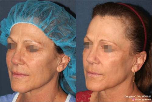 Laser resurfacing is one of the most effective ways to tighten the skin, remove wrinkling and fine lines that give a dull tired appearance.