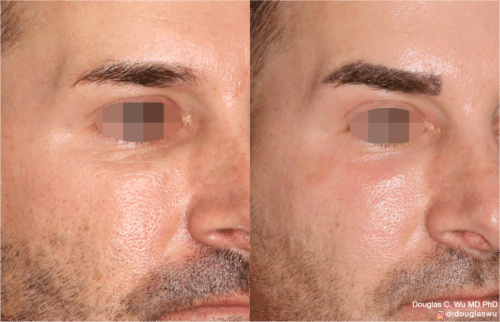 Laser resurfacing is one of the most effective ways to tighten the skin, remove wrinkling and fine lines that give a dull tired appearance.