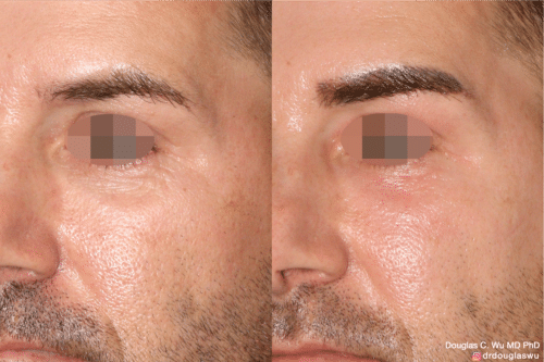 Laser resurfacing is one of the most effective ways to tighten the skin, remove wrinkling and fine lines that give a dull tired appearance.