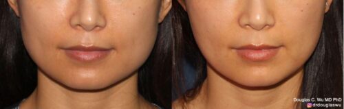 Botox for jawline slimming