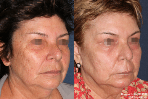 Laser resurfacing is one of the most effective ways to tighten the skin, remove wrinkling and fine lines that give a dull tired appearance.