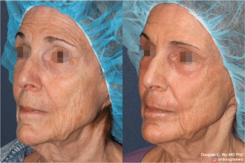 Laser resurfacing is one of the most effective ways to tighten the skin, remove wrinkling and fine lines that give a dull tired appearance.