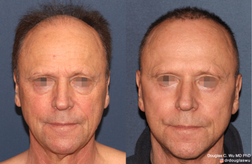 Laser resurfacing is one of the most effective ways to tighten the skin, remove wrinkling and fine lines that give a dull tired appearance.