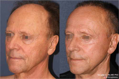 Laser resurfacing is one of the most effective ways to tighten the skin, remove wrinkling and fine lines that give a dull tired appearance.