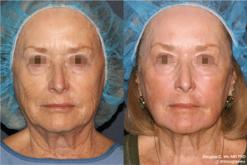 Laser resurfacing is one of the most effective ways to tighten the skin, remove wrinkling and fine lines that give a dull tired appearance.