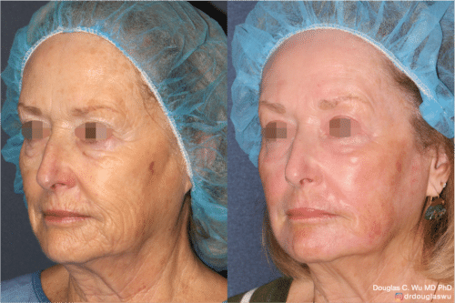 Laser resurfacing is one of the most effective ways to tighten the skin, remove wrinkling and fine lines that give a dull tired appearance.