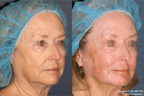 Laser resurfacing is one of the most effective ways to tighten the skin, remove wrinkling and fine lines that give a dull tired appearance.