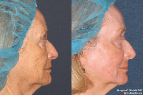 Laser resurfacing is one of the most effective ways to tighten the skin, remove wrinkling and fine lines that give a dull tired appearance.