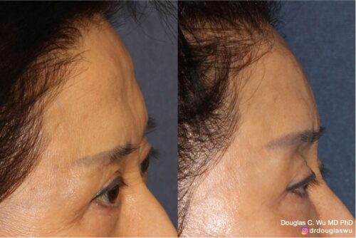 Forehead contouring with filler