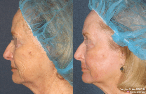 Laser resurfacing is one of the most effective ways to tighten the skin, remove wrinkling and fine lines that give a dull tired appearance.