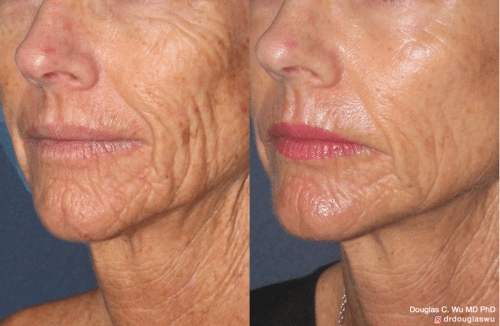 Laser resurfacing is one of the most effective ways to tighten the skin, remove wrinkling and fine lines that give a dull tired appearance.