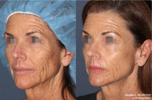 Laser resurfacing is one of the most effective ways to tighten the skin, remove wrinkling and fine lines that give a dull tired appearance.