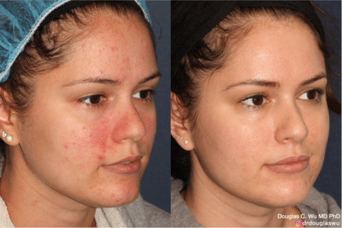 Acne and Rosacea Treatment performed with Photodynamic Therapy (PDT)