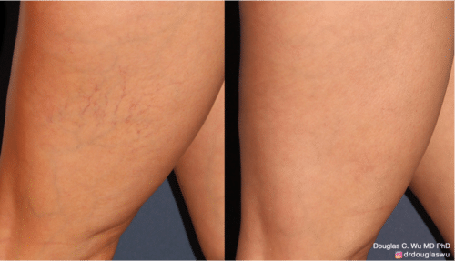 Sclerotherapy to improve the appearance of spider or varicose veins