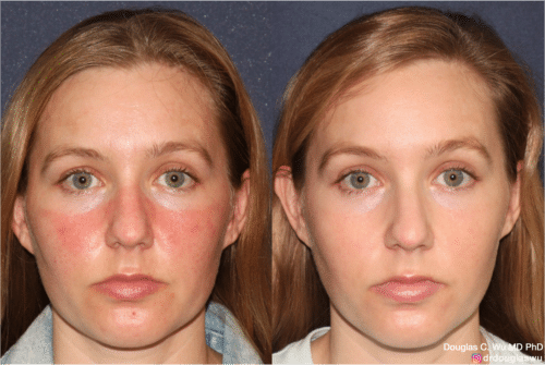 Improved the appearance of Rosacea with Vbeam and IPL laser treatments