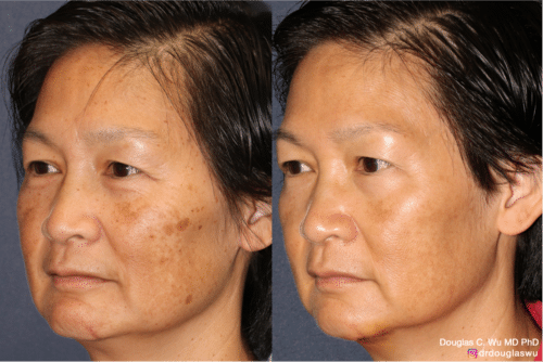 PicoUltra laser resurfacing to improve skin tone