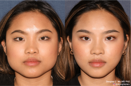 Jawline slimming with Botox injection