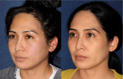 Customized maintenance treatment