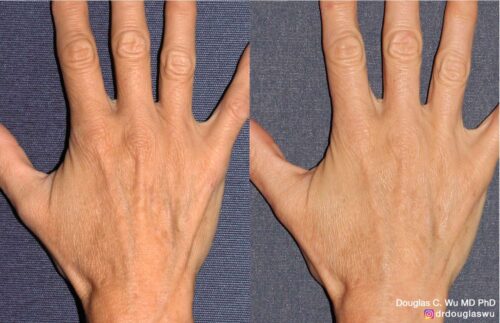 Hand re-volumization