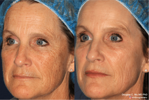 Sun damage treated with Picoway, VBeam, and FraxPro