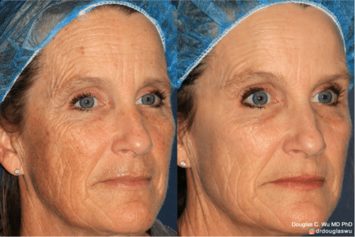 Sun damage treated with Picoway, VBeam, and FraxPro