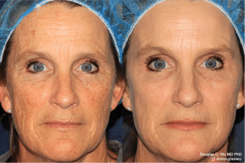 Sun damage treated with Picoway, VBeam, and FraxPro