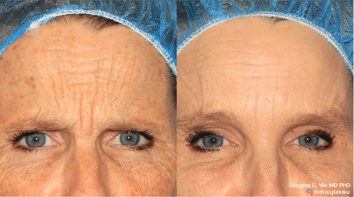 Appearance of frown lines treated with Botox