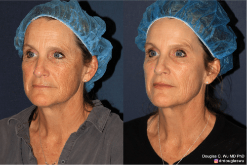 Sun damage treated with Picoway, VBeam, and FraxPro