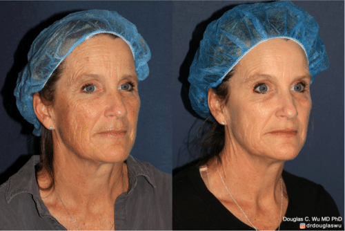 Sun damage treated with Picoway, VBeam, and FraxPro